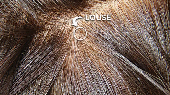 Example of head louse in the hair