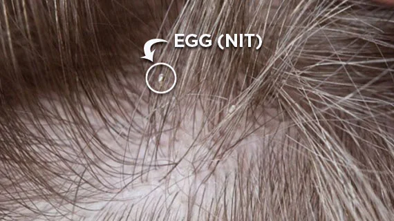 Example of lice egg on hair shaft